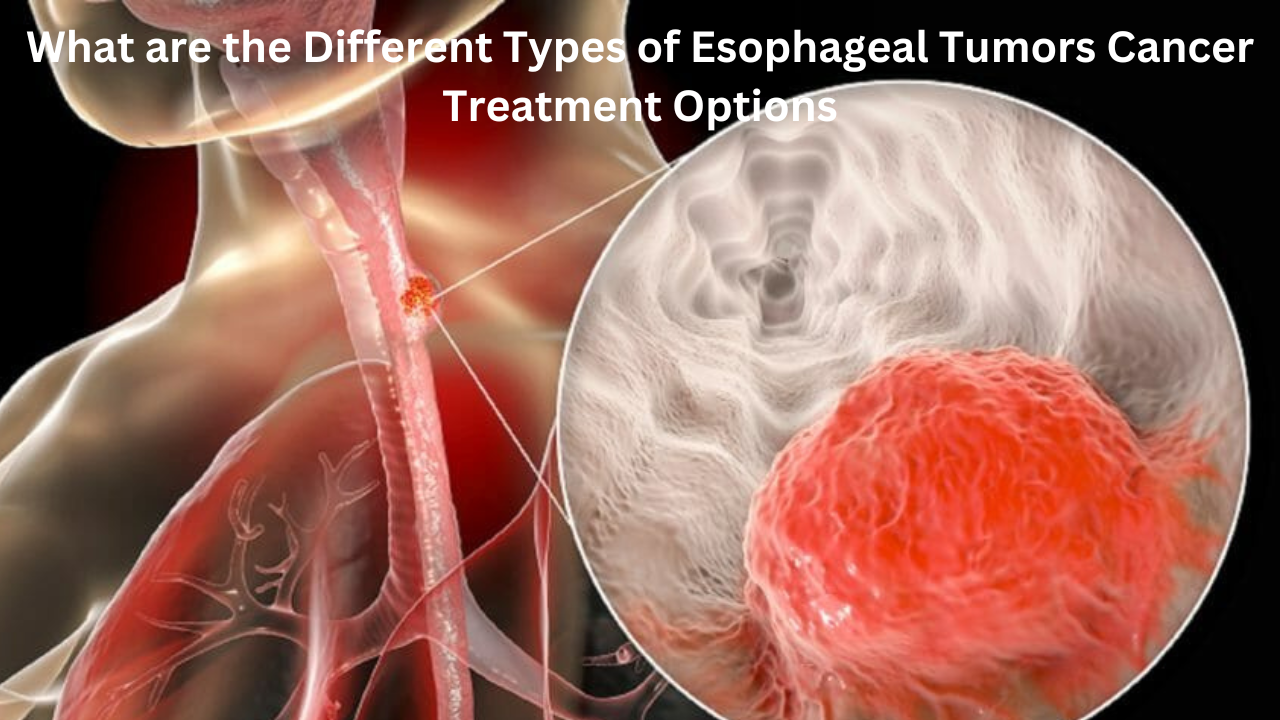 Esophageal Tumors Cancer