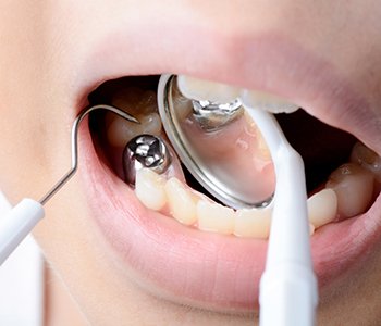 The Benefits of Gilbert Mercury-Free Dentists Composite Fillings