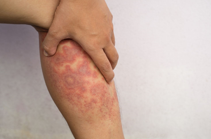 Understanding Eczema & Knowing When It’s Time to Seek Professional Help